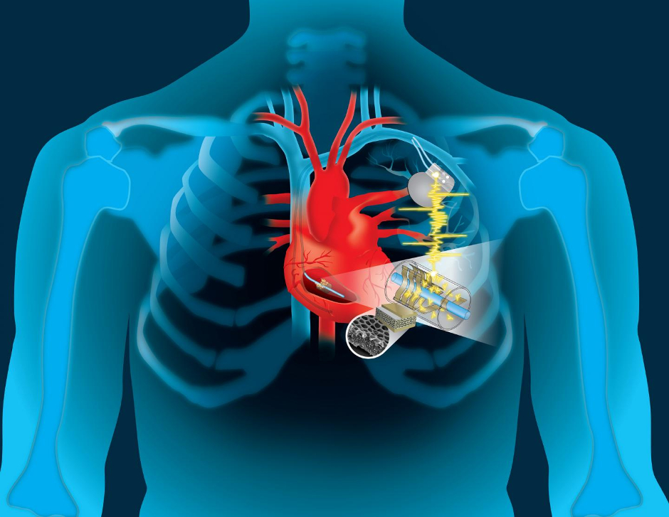 Global Implantable Medical Devices Market Size Worth US$ 148.8 Billion by 2024 | CAGR 7% Global Implantable Medical Devices Market Size Worth US$ 148.8 Billion by 2024 | CAGR 7%