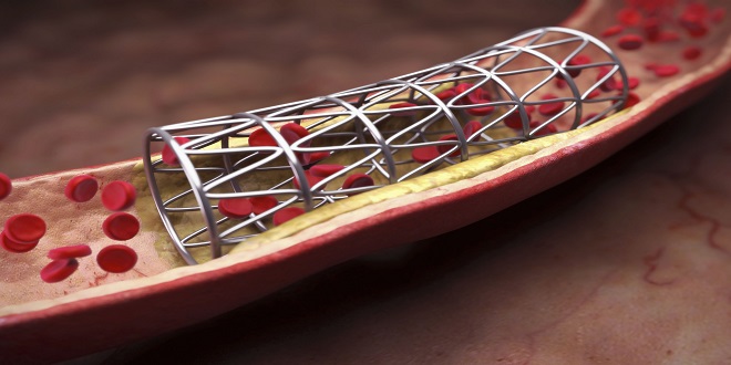 Coronary Stents Market 2019 | Technology Advancement Trends, Key Financials, Segmental & Geographical Revenue, Industry Growth Rate By 2023