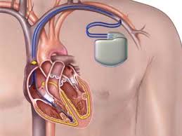 New Research Study on Implantable Cardioverter Defibrillator Market 2019 to 2024 | Nihon Kohden, Boston Scientific, Medtronic