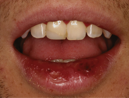 Gingivostomatitis Market 2019: Global Share, Comprehensive Research Study,  Business Growth, Regional Trends, Competitive Landscape, Emerging Opportunities, Future Plans and Industry Outlook 2023
