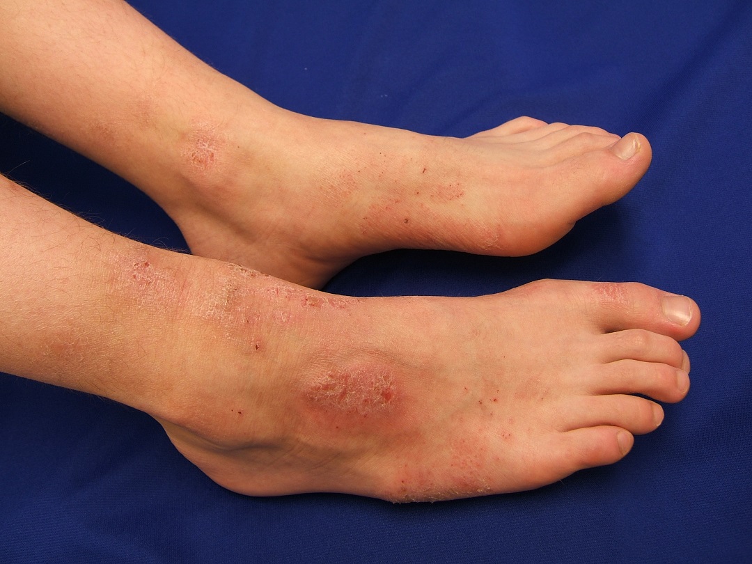 Atopic Dermatitis Market 2019: Analysis by By Mechanism of Action Type, Mode of Administration, Drug Type, Distribution Channel, Application, Growth, Outlook and Global Forecast to 2026