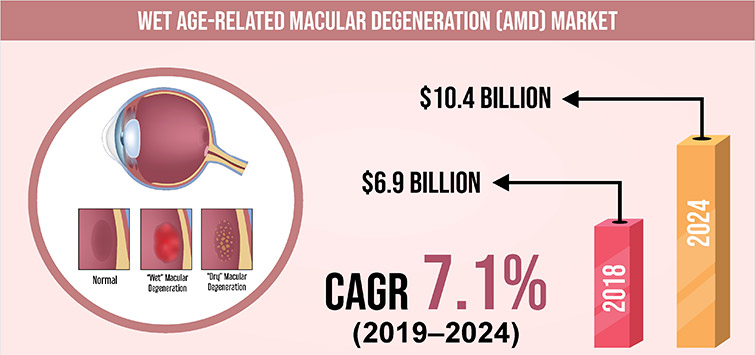 Surging Geriatric Population Driving the Wet Age-Related Macular Degeneration (AMD) Market Growth 