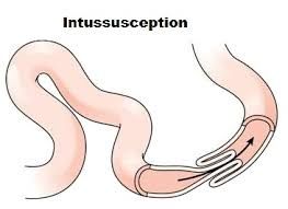 Intussusception Market 2019 Global Overview, Treatment Strategy | Healthcare Industry Size, Trends, Emerging Technologies and Growth Rate Analysis by Forecast 2023