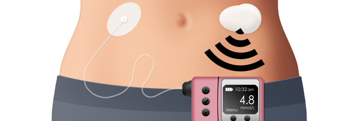 Insulin Pumps Market Report, Global Industry Overview, Growth, Opportunities and Forecast 2019-2024 | IMARC Group Insulin Pumps Market Report, Global Industry Overview, Growth, Opportunities and Forecast 2019-2024 | IMARC Group