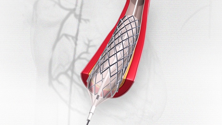 Stents Market is expected to grow at a CAGR of $16,666 by 2022 | Allied Market Research
