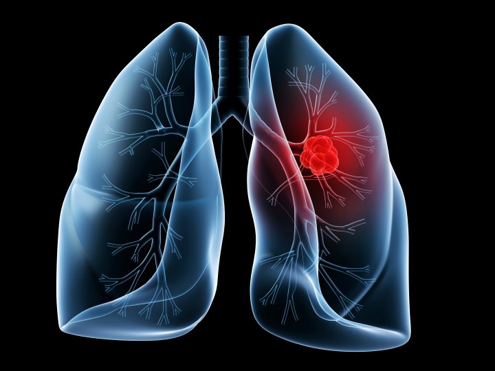 Non-Small Cell Lung Cancer Market Huge Growth Opportunities and Challenges to Watch in 2019
