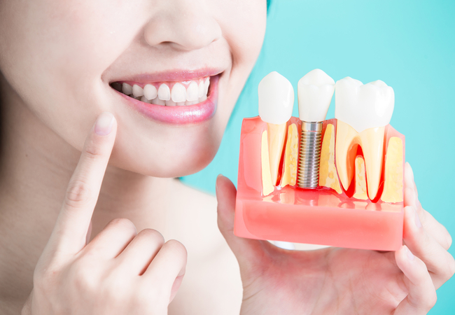 Dental Implants Market to surpass US$ 6269.8 Million by 2024 - Coherent Market Insights