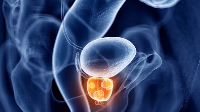 Prostate Cancer Therapeutics Market - A Well-Defined Technological Growth Map With An Impact-Analysis | Top Players Johnson & Johnson, Astella, Inc, Sanofi-Aventis, Bayer AG, AstraZeneca Plc, Pfizer, etc.