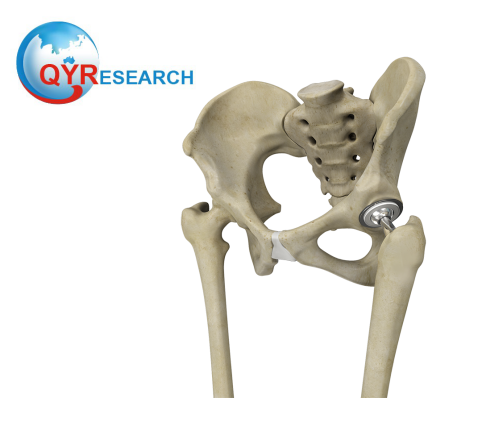 Bone Replacement Market Overview 2019 - 2025: QY Research
