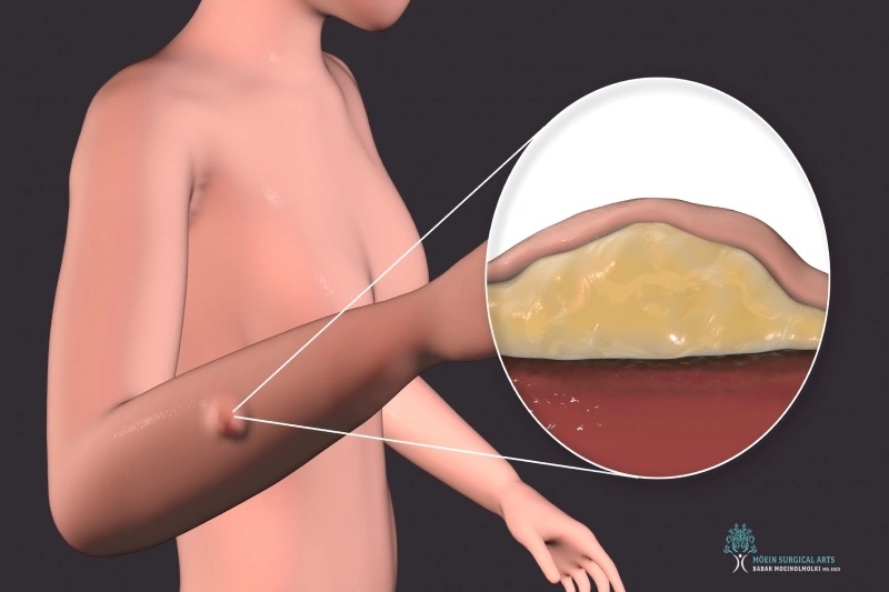 Understanding Lump and Bump Removal: When Is Surgery Needed? Understanding Lump and Bump Removal: When Is Surgery Needed?