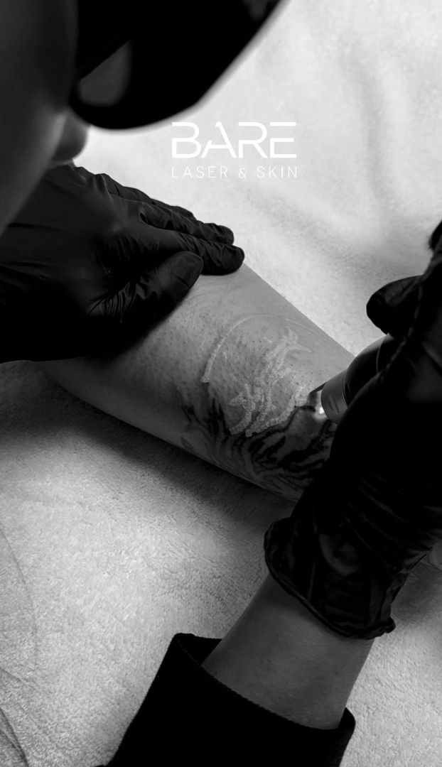 BARE Laser & Skin Extends Hours and Welcomes New Clients for Professional Laser Tattoo Removal in London, Ontario BARE Laser & Skin Extends Hours and Welcomes New Clients for Professional Laser Tattoo Removal in London, Ontario