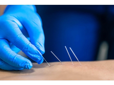 What Does Dry Needling Austin Actually Do? Austin Clinic Reports Growing Demand for Muscle Pain Treatment What Does Dry Needling Austin Actually Do? Austin Clinic Reports Growing Demand for Muscle Pain Treatment