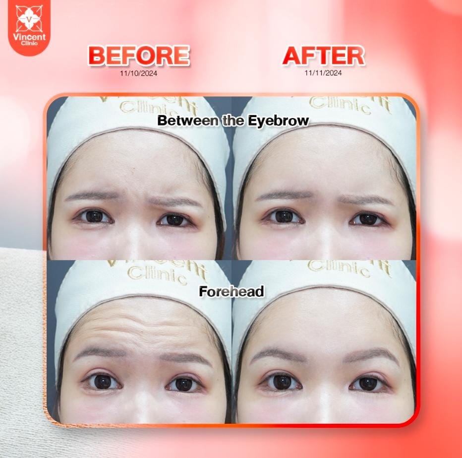 How Botox Bangkok Works and How Long the Results Can Last How Botox Bangkok Works and How Long the Results Can Last