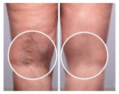 Elite Veins New York Combines Cardiology Expertise with Advanced Vein Treatment in Manhattan Elite Veins New York Combines Cardiology Expertise with Advanced Vein Treatment in Manhattan