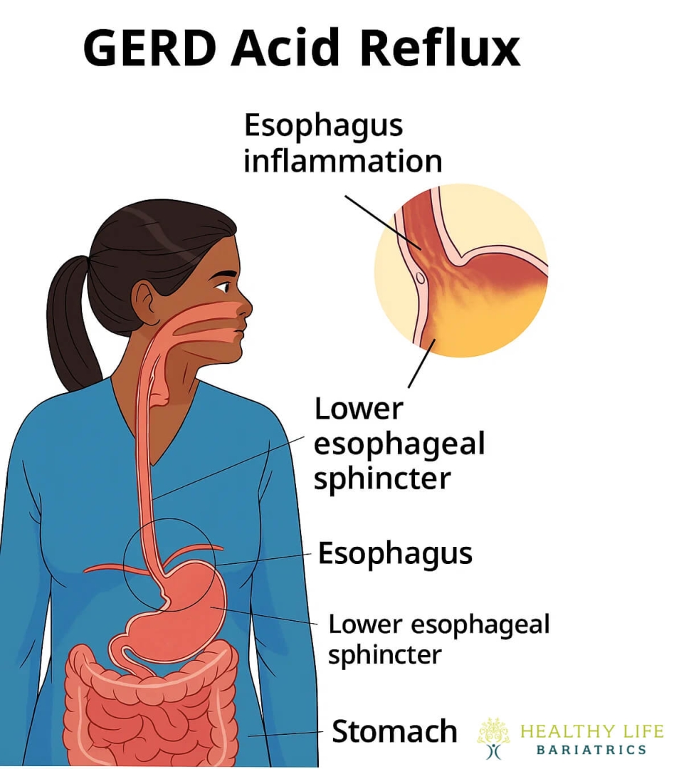 GERD Explained: Causes, Symptoms, and Risks GERD Explained: Causes, Symptoms, and Risks