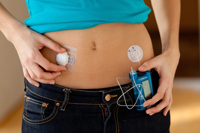 Artificial Pancreas Market Estimated Share Rise with a 15.2% CAGR By Industry Developments in Control and Treatment Types, Future Trends and Regional Landscapes Till – 2023 by Top Key Players