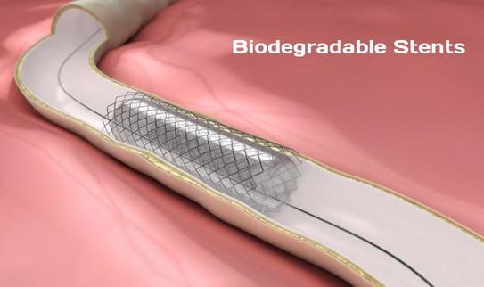 Global Biodegradable Stents Market to Surpass US$ 0.8 Billion by 2026 | Say No to Infinite Stay of Foreign Material