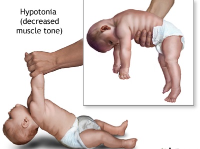 Hypotonia Market  is expected to grow at a CAGR of Approx. 5.8% By 2023 With Size, Share, Growth, Upcoming Trends, Top 10 Major Companies, By Types, Diagnosis and Treatment