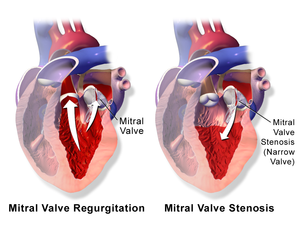 Mitral Valve Stenosis Market Global Outlook 2019, Industry Analysis by Diagnostic Test, Treatment, Market Growth, Size, Share, Trends, Top Companies, Regional Insight by 2023