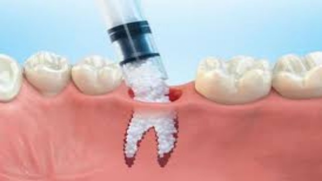 Tooth Regeneration Market Dental Industry as Research Activities Accelerate Globally | Coherent Market Insights