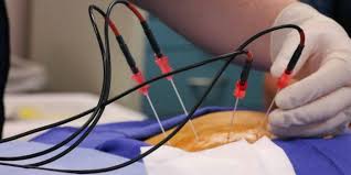 Ablation Technologies Market to Set Remarkable Growth by 2025| Leading Key Players – Medtronic, AtriCure, Dornier MedTech