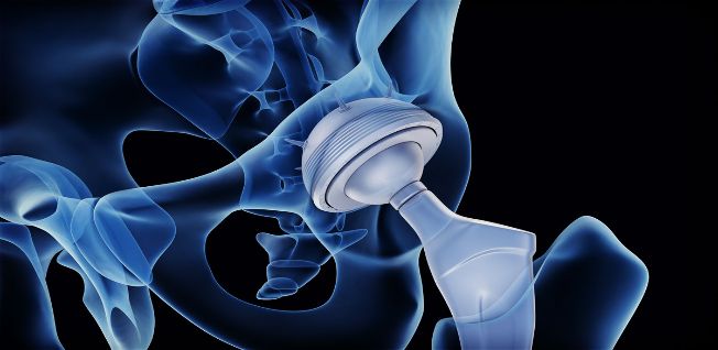 Artificial Joints Market to Surge at a Robust Pace in Terms of Revenue 2018 - 2026 Artificial Joints Market to Surge at a Robust Pace in Terms of Revenue 2018 - 2026