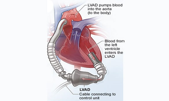 UAE Ventricular Assist Device Market is Projected to Expand at a Compound Annual Growth Rate (CAGR) of 10.8% From 2018 to 2026