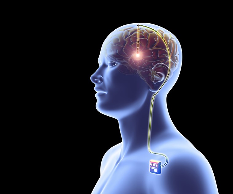 Brain Implants Market Set to take Giant Positive Leap 