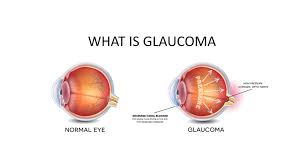 Glaucoma Market New Innovative Solutions to Boost Global Growth by 2025 | Novartis, Glaukos, New World Medical, Ellex Medical Lasers