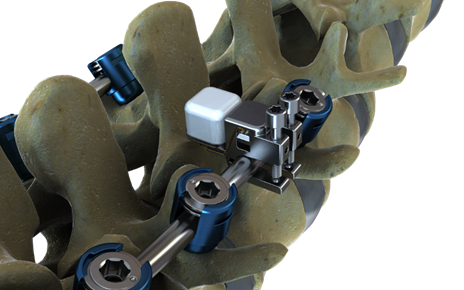 Global Spinal Implants and Devices Market Report 2020 to 2025 Market Analysis, Size, Share, Trends, Key Players, Drivers and Forecast