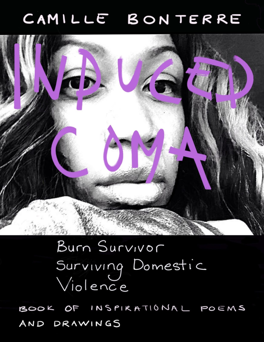 Acid Attack Victim Tells Her Story About Domestic Violence in New Book Acid Attack Victim Tells Her Story About Domestic Violence in New Book