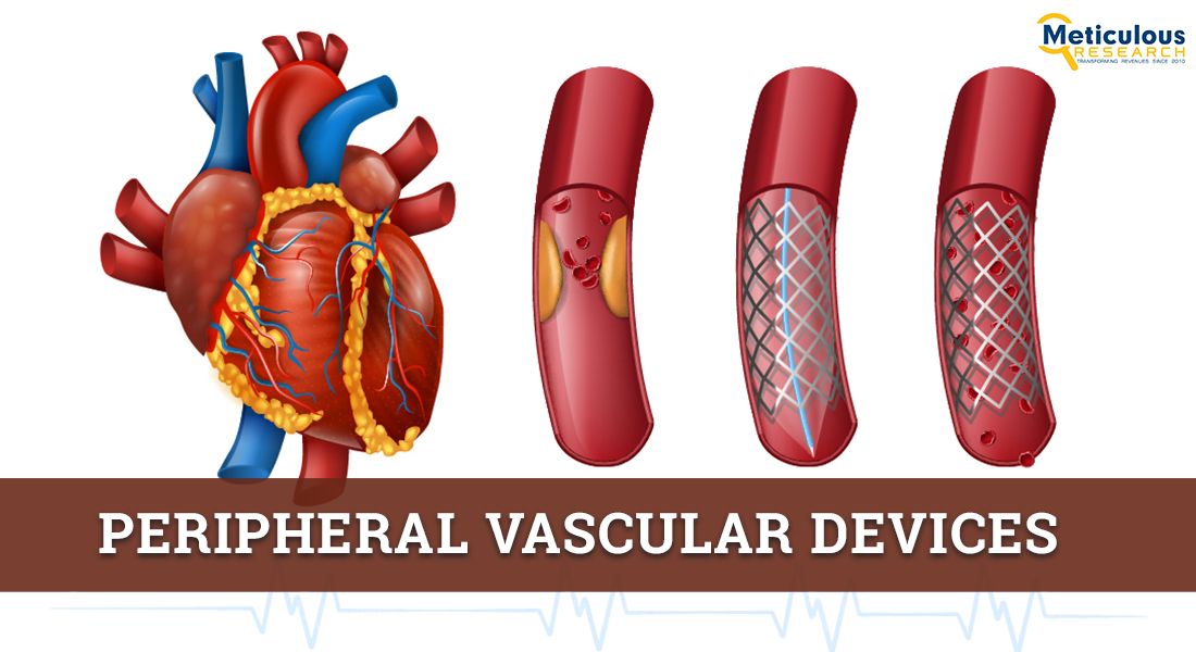 Peripheral Vascular Devices Market: Meticulous Research® Reveals Why This Market is Growing at a CAGR of 6.9% to Reach $12.02 Billion by 2028