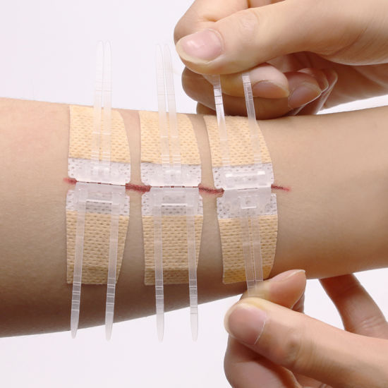 Wound Closure Strips Market To Observe Exponential Growth By 2021-2031