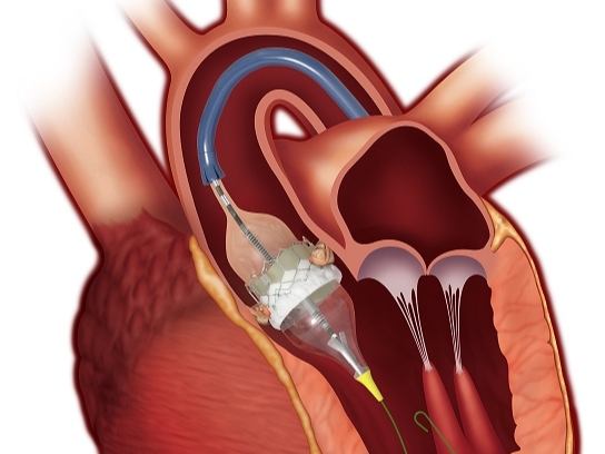 Cardiovascular Devices Market Share 2021: Global Trends, Demand Technological Advancements And Boosting Industry Growth by 2031