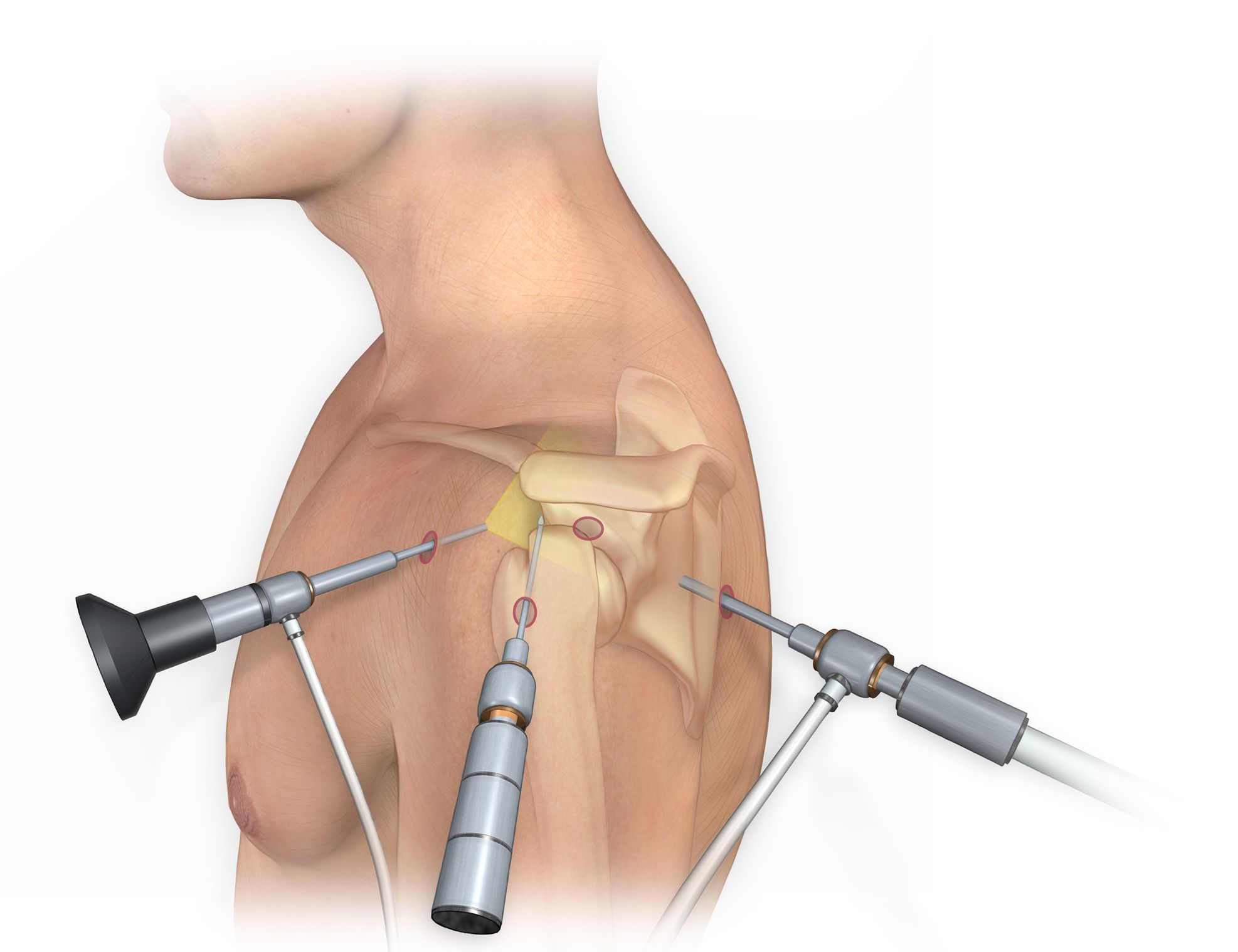 Arthroscopy Devices Market Driven by Increase in Procedures to Reach $10.5 Billion by 2031
