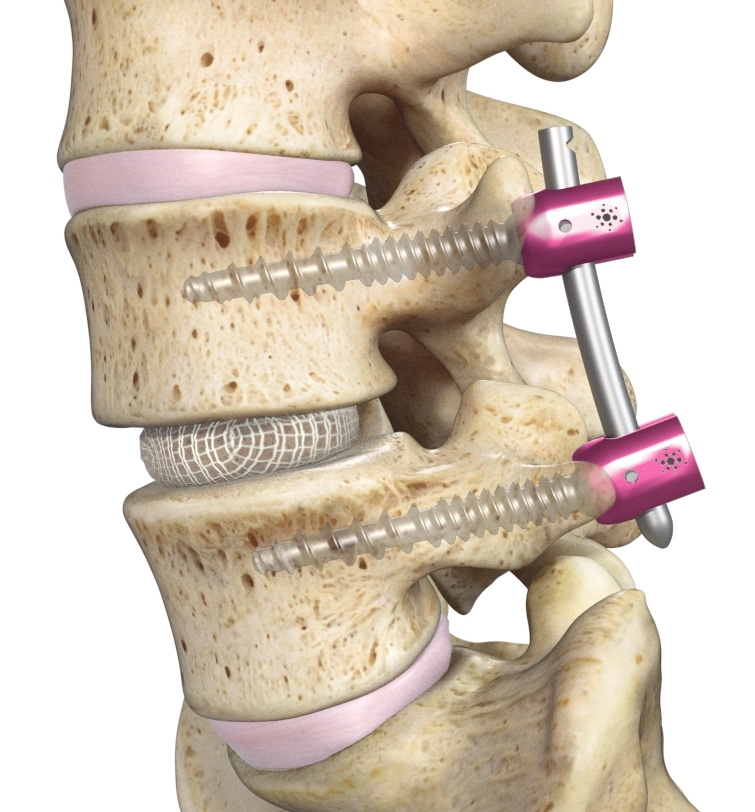 Spinal Fusion Devices Market 2021 Players Targeting Application to Boost Growth by 2031