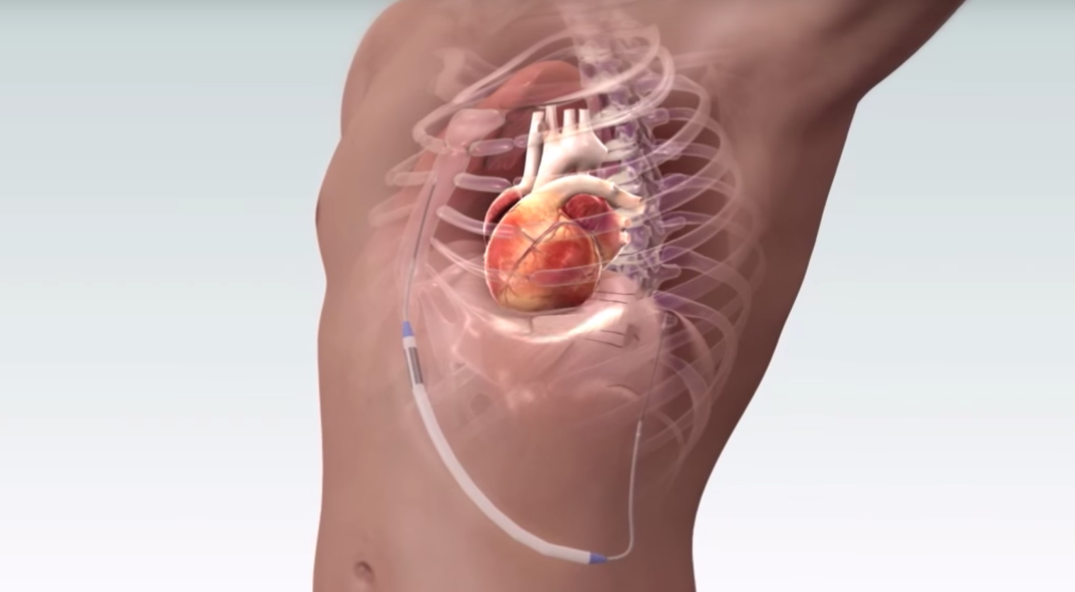 Electrophysiology Devices Market to Flourish with an Impressive CAGR during 2021-2031