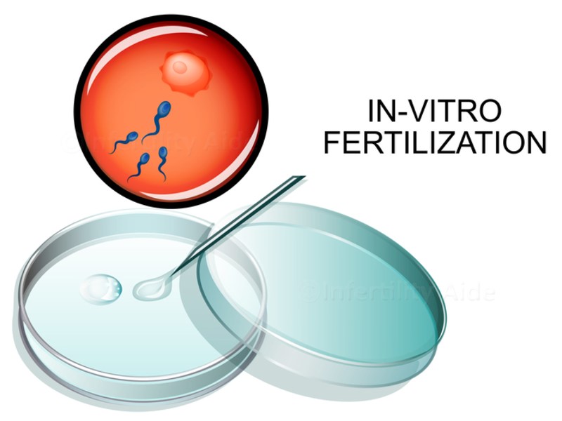 In Vitro Fertilization (IVF) Market to Receive Overwhelming Hike in Revenue That Will Boost Overall Industry Growth and Forecast to 2031
