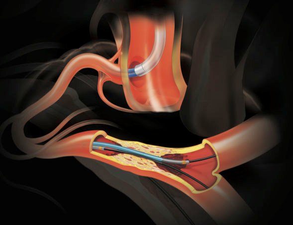 Micro Guide Catheters Market To Register Incremental Growth During The Forecast Period 2031