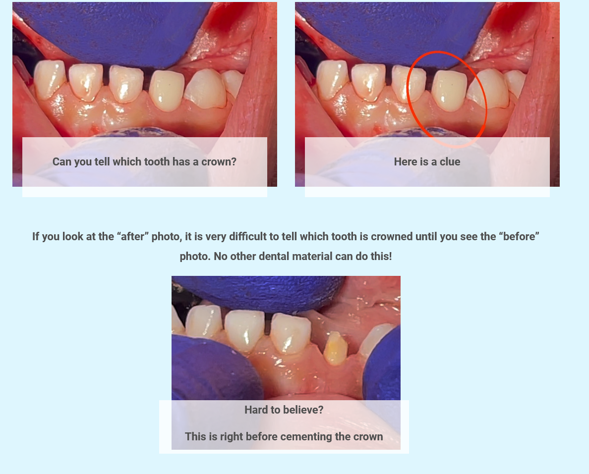 Dallas Fort Worth Pediatric Dentist Offers Ability For All White Zirconia Crowns Alternative To Silver For Baby Teeth