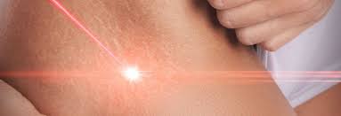 Stretch Marks Treatment Size, Key insights Analysis, Segments and Extensive Key Players Profiles analysis by 2030