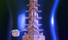 Spine Bone Stimulators Size and Share 2022: Global Growth Analysis by Industry Segments, Demand Status, Product Type, Regional Revenue Analysis, Comprehensive Research Forecast to 2030