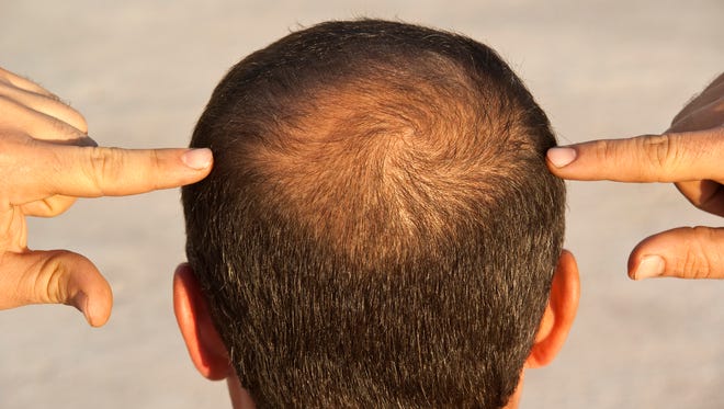 Global Alopecia Treatment Market Report 2022: Industry Size, Share Growth and Forecast 2027