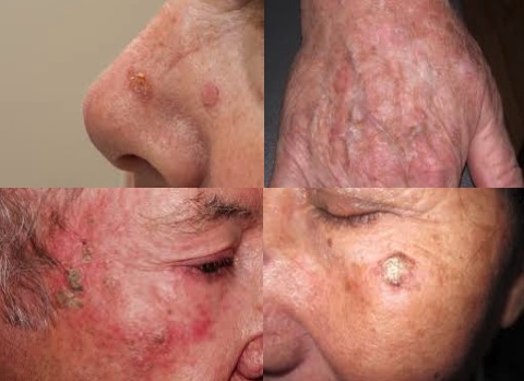 Actinic Keratosis Treatment Market Size, Share, Growth Potential, Opportunities & Trends 2022-2027 | 3M Company, Almirall SA