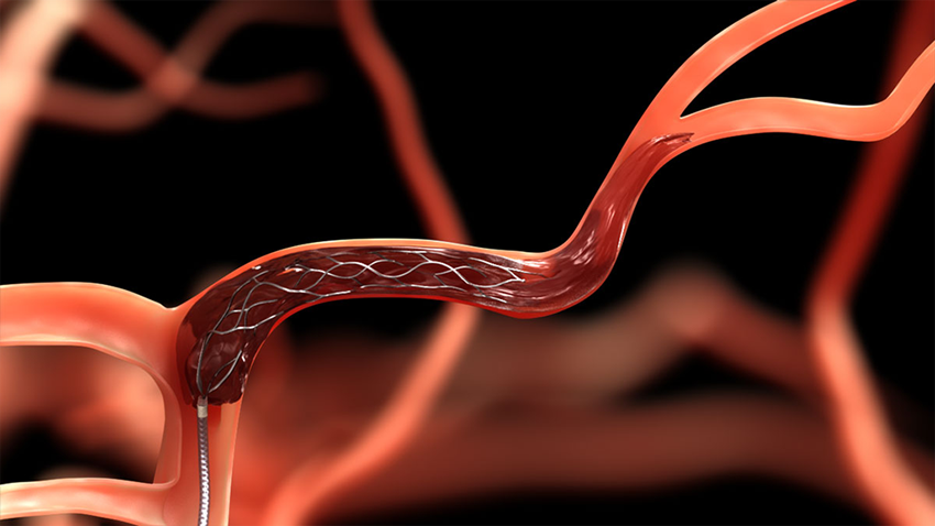 Thrombectomy Devices Market Share, Size, Growth And Analysis Report 2023-2028