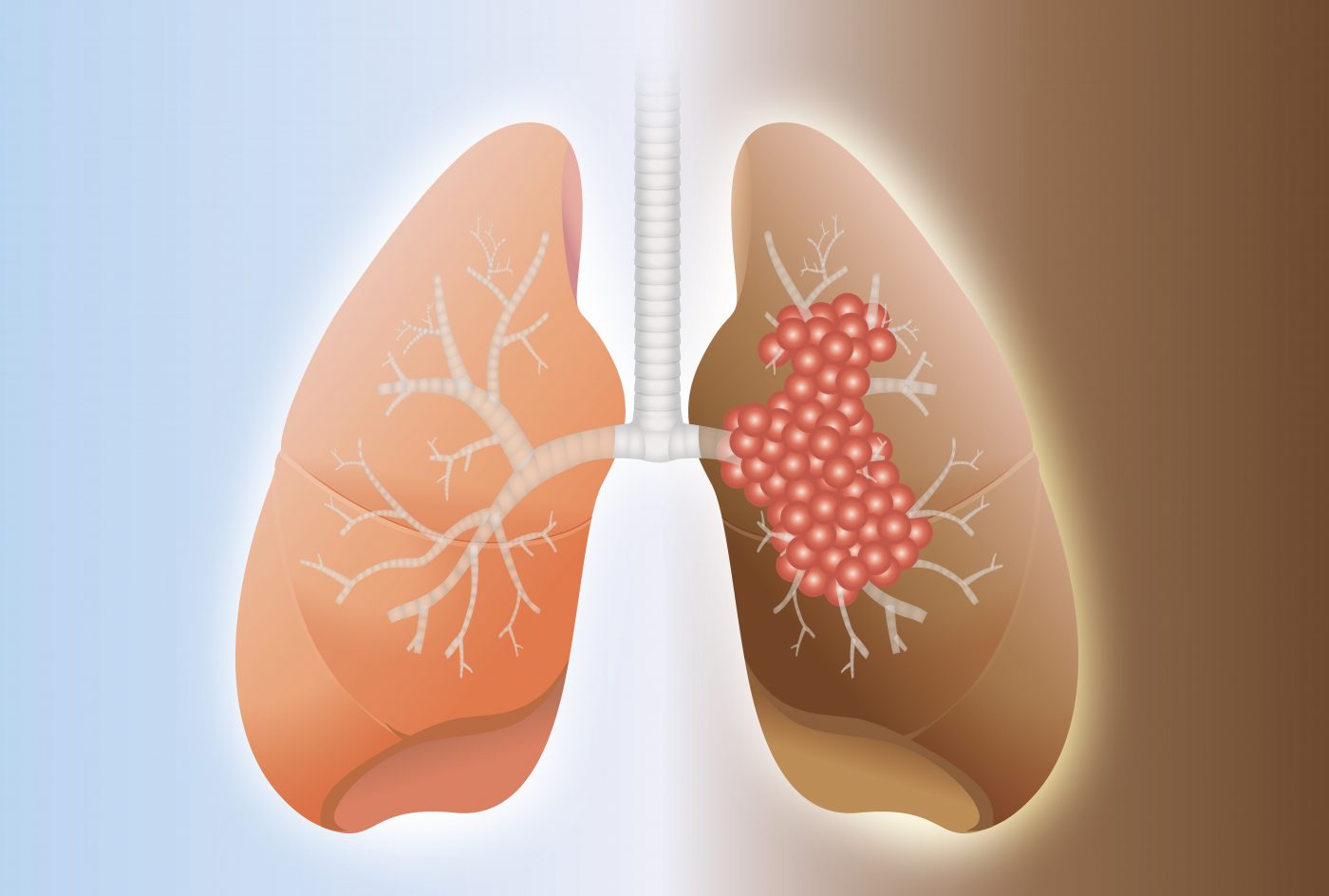 India Idiopathic Pulmonary Fibrosis Treatment Market, Growth Insight, Epidemiology, Demand, Opportunity and Forecast by 2022-2027