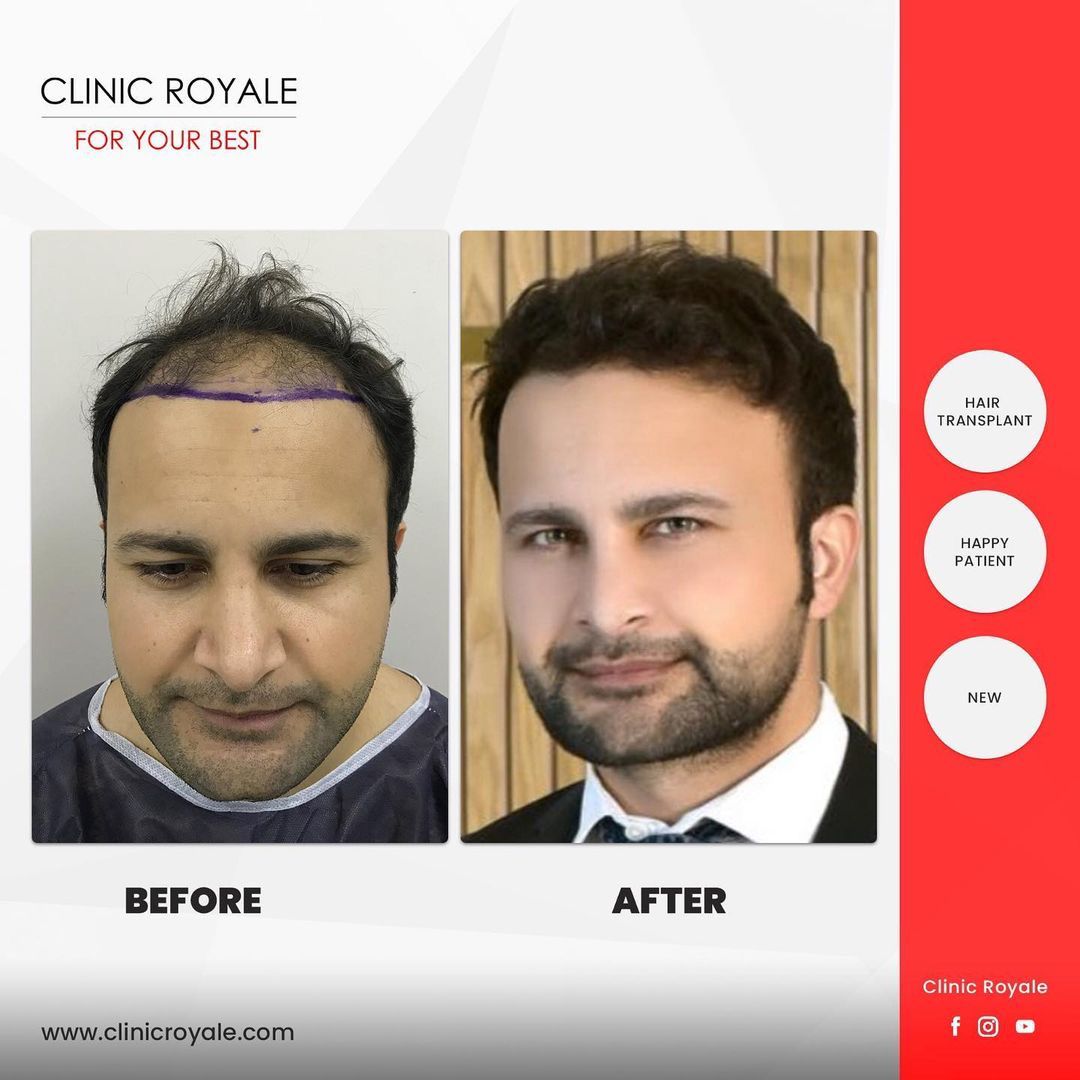 Best Hair Transplant in Istanbul: Clinic Royale